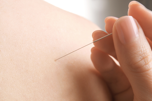 Woman,Stimulating,Acupuncture,Points,On,Patient's,Back,,Closeup